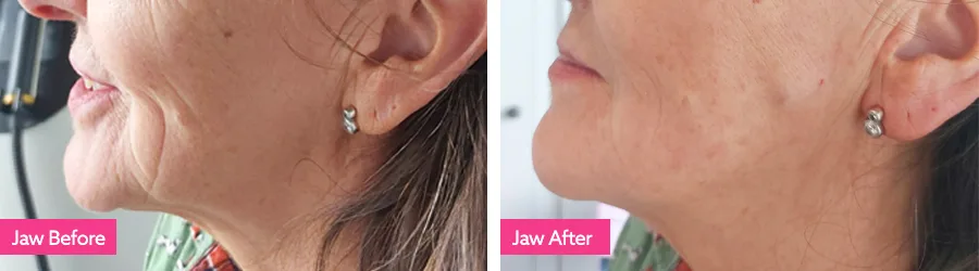 pdo thread treatment before and after photos of womans face