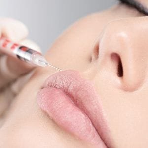 woman having a lip filler injection in her upper lip